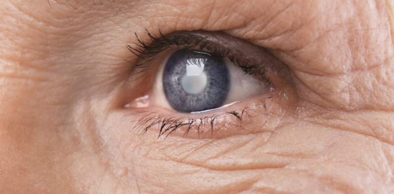 A close-up of an eye with clouded lenses showing signs of cataracts.